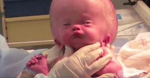 Μωρό γεννιέται με τεράστιο, πρησμένο κεφάλι! 20 μήνες αργότερα? Ακόμη και οι Γιατροί ΔΕΝ μπορούν να πιστέψουν στα μάτια τους!