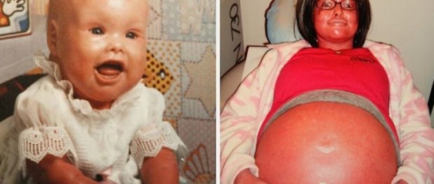 Έγκυος είχε μία πολύ σπάνια πάθηση.. Μόλις γέννησε, οι γιατροί της είπαν πως δεν είχαν ξαναδεί μωρό σαν το δικό της!