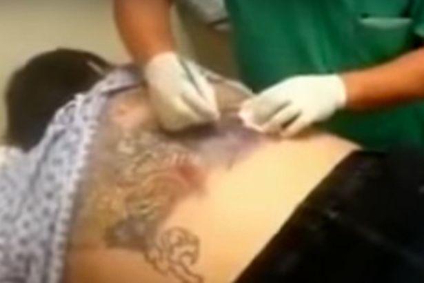 Η απόλυτη αηδία: Μολύνθηκε το τατουάζ της και δεν θα πιστέψετε τι βγήκε από μέσα