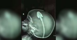 Ένα πολύπριζο είχε σφηνώθηκε στο κεφάλι του ενός αγοριού. Η ακτινογραφία αυτού του μικρού παιδιού έχει γίνει διεθνές πρωτοσέλιδο.