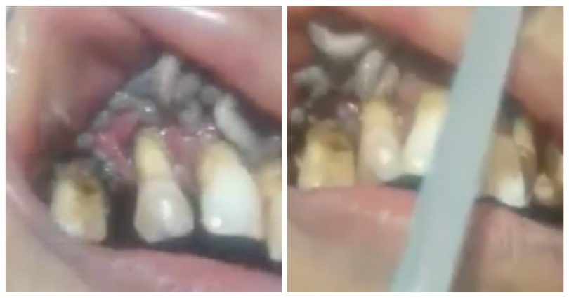 Οδοντίατρος ανοίγει το στόμα ασθενούς και βλέπει δεκάδες σκουλήκια ανάμεσα στα κίτρινα δόντια του