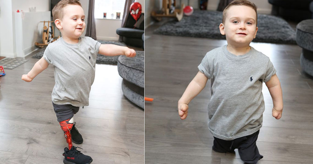 3χρονος που έχασε τα πόδια του από μηνιγγίτιδα έκανε τα πρώτα του βήματα με προσθετικά άκρα