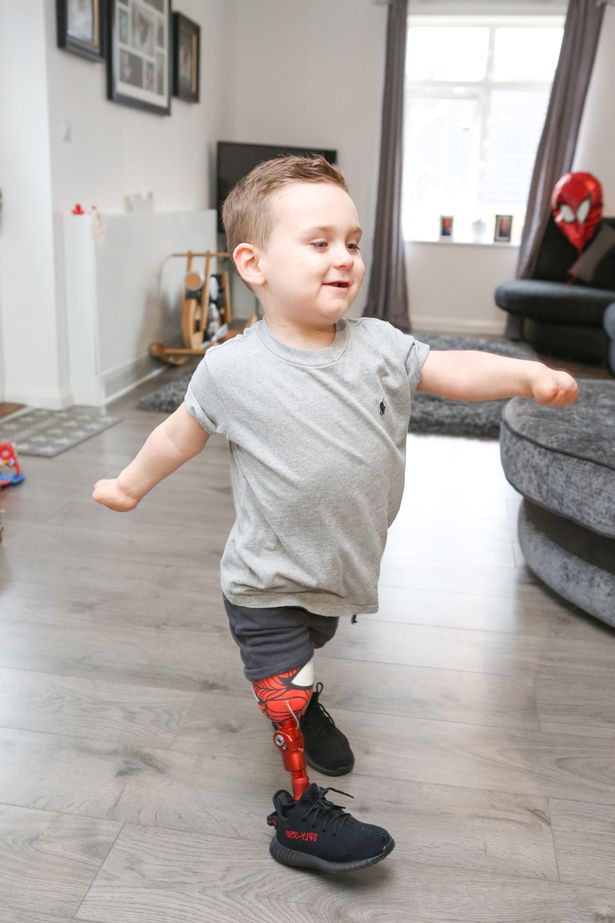 3χρονος που έχασε τα πόδια του από μηνιγγίτιδα έκανε τα πρώτα του βήματα με προσθετικά άκρα