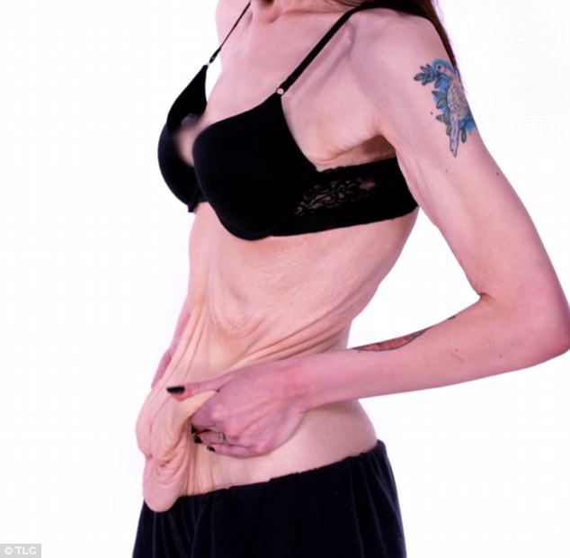 Γυναίκα που έχασε 148 κιλά θέλει απεγνωσμένα να ξεφορτωθεί το περισσευούμενο δέρμα της
