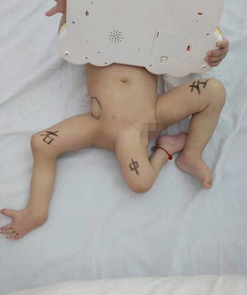 Μωρό στην Κίνα γεννήθηκε με 3 πόδια