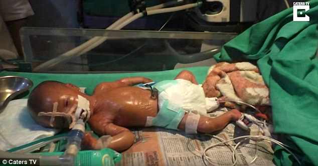 The baby, which has not yet been named, was born with a condition called lamellar ichthyosis, which makes the skin tight, shiny and plastic-looking