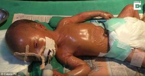 Μωρό στην Ινδία γεννήθηκε με σκληρό και γυαλιστερό δέρμα που το κάνει να μοιάζει με πλαστική κούκλα