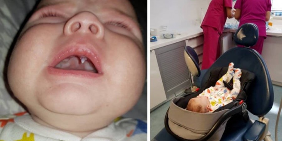 Σοκαρισμένοι γιατροί με μωρό που έβγαλε κυνόδοντα «βρικόλακα»